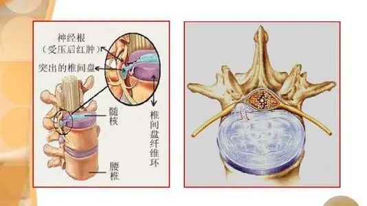 腰椎间盘突出，手术并非最好的治疗方法。中医正骨有说道