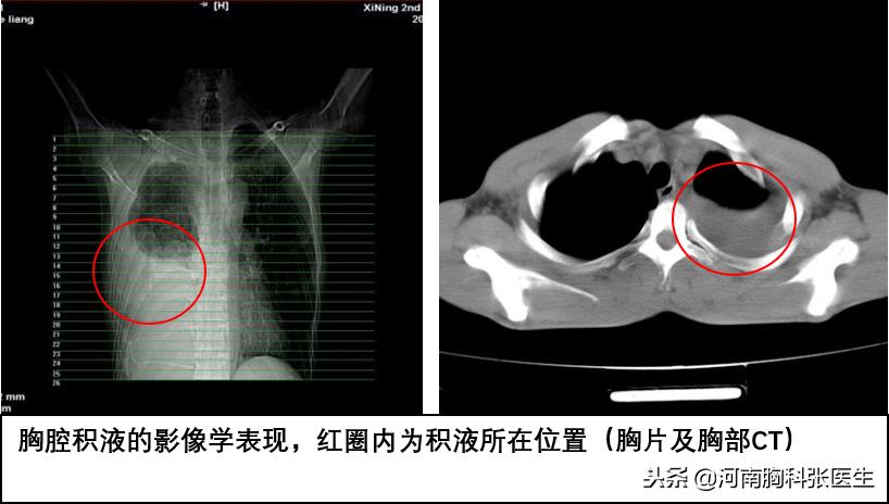 胸腔积液查不出病因怎么办,胸腔积液的病人如何听诊