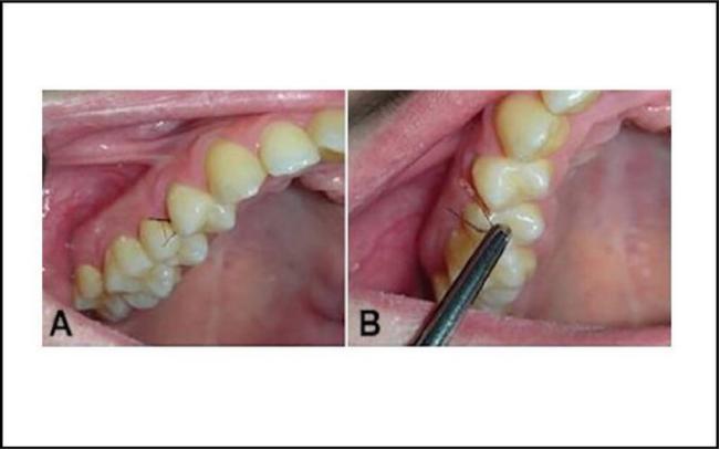 女性患多毛症,女孩患罕见疾病满脸长毛
