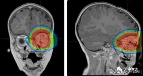 质子治疗手术适合大型肿瘤,肿瘤不能根治吗