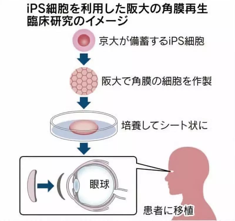 眼疾患者一大福音！全球首例iPS细胞培养角膜移植成功