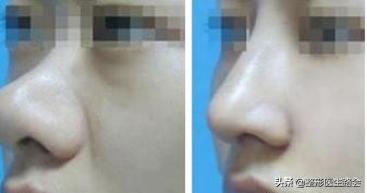 鼻头变厚变大怎么恢复,为什么瘦了鼻头变大