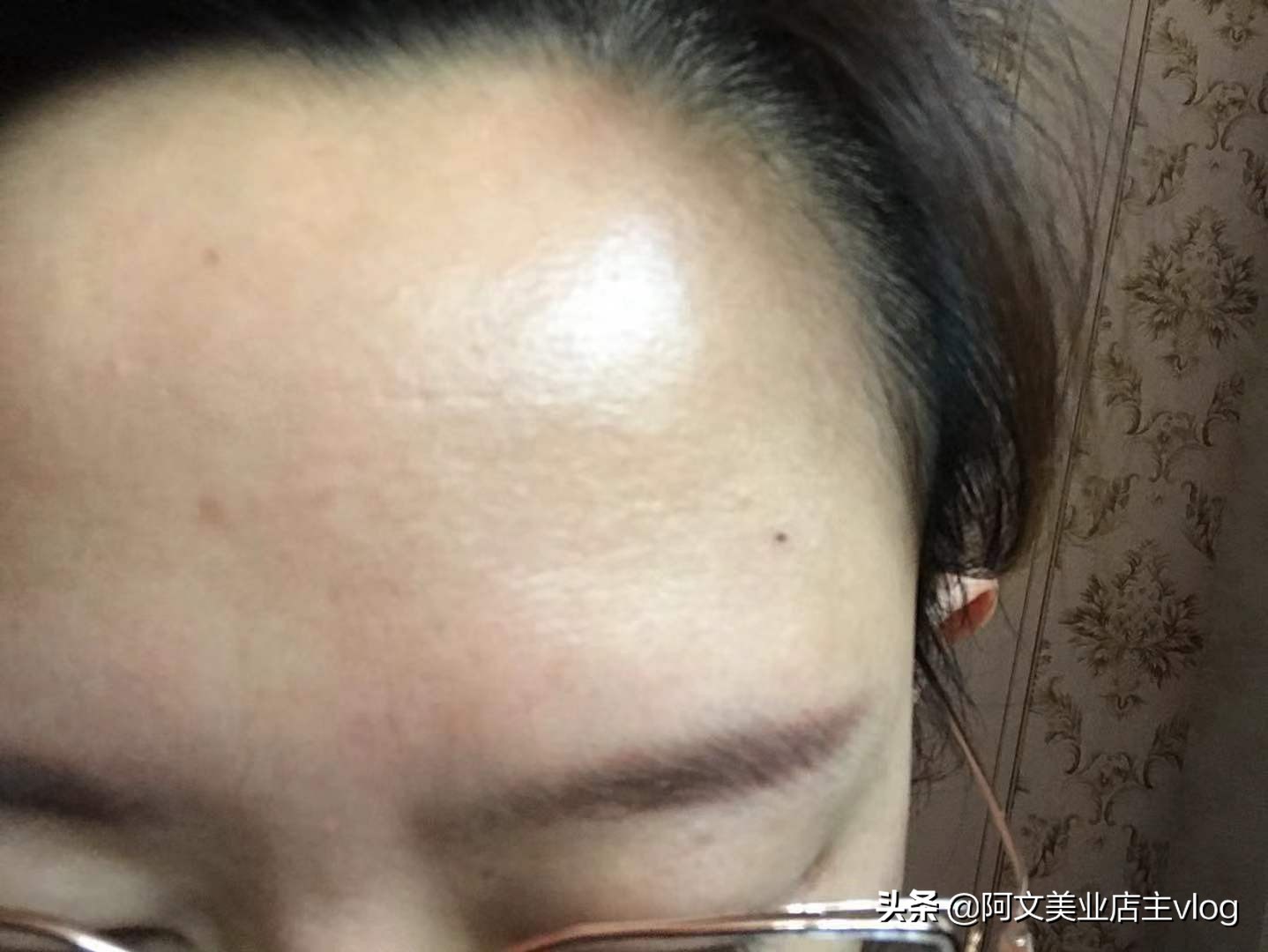 阿文讲她的青春痘扁平疣历史，分享护肤小知识