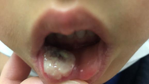 7岁宝宝嘴唇溃疡一大片，原因竟然是这个！#雅悦齿科#