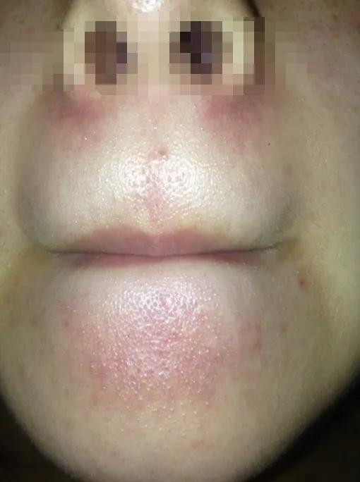 鼻子两侧毛孔粗大是什么原因,毛孔粗大原因及如何改善