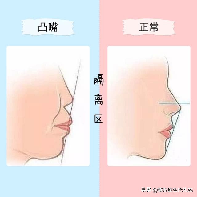 从医学来讲法令纹怎么改善比较好,整形医生怎么解决法令纹的问题