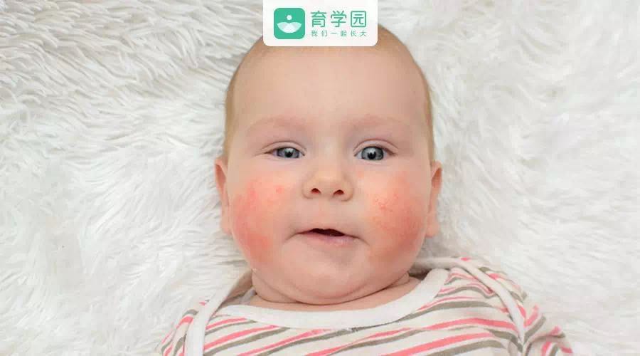 湿疹拉肚子是什么原因,宝宝湿疹拉肚子怎么办