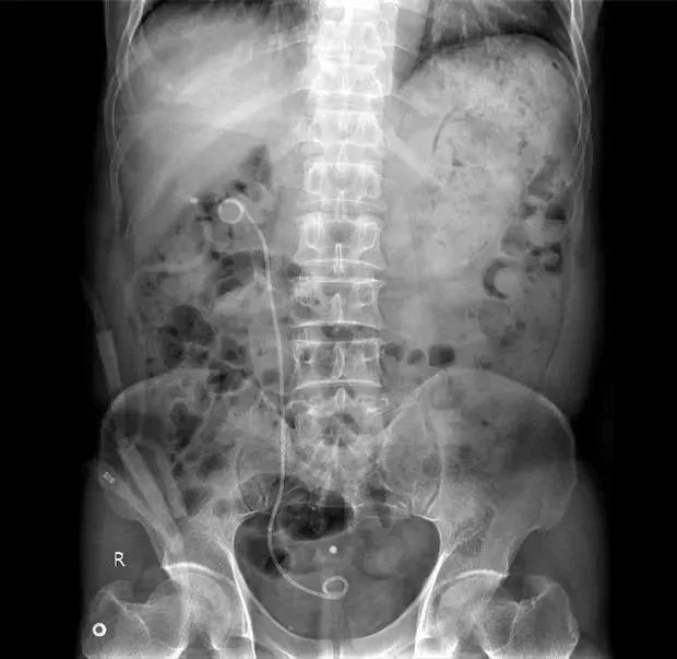 肾结石开刀后怎么调理,肾结石微创手术有两种方法