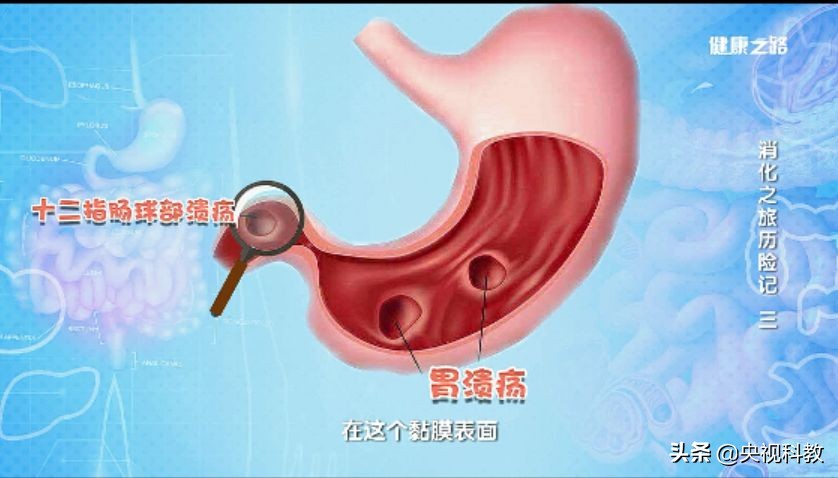 幽门螺旋杆菌胃出血怎么治疗,胃出血幽门螺杆菌患者可以吃什么