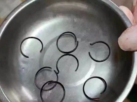 女子私密处竟塞入弹簧，原因令人哭笑不得