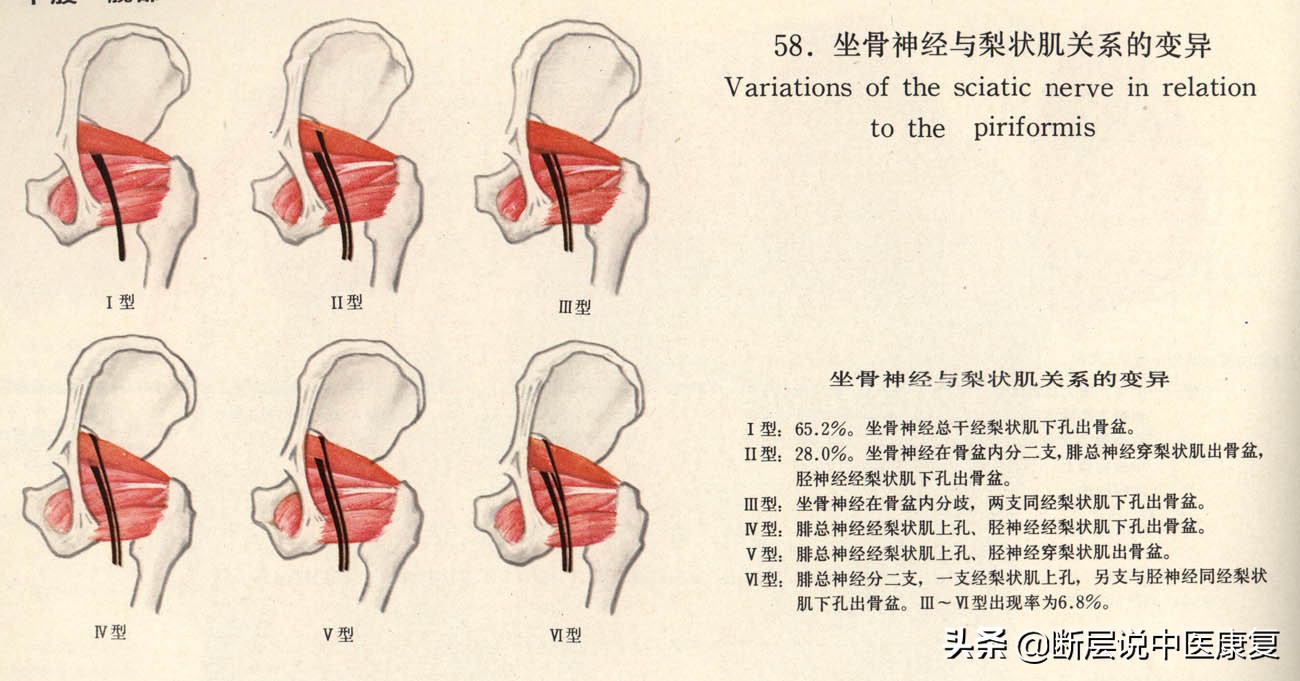 怎样才能治好梨状肌综合征,如何治疗梨状肌综合征