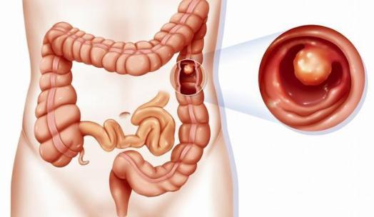 查出来有息肉需要直接做手术吗,查出息肉