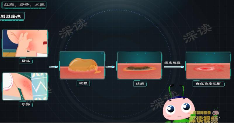 宝宝起湿疹痒不痒,宝宝起湿疹是天气热吗