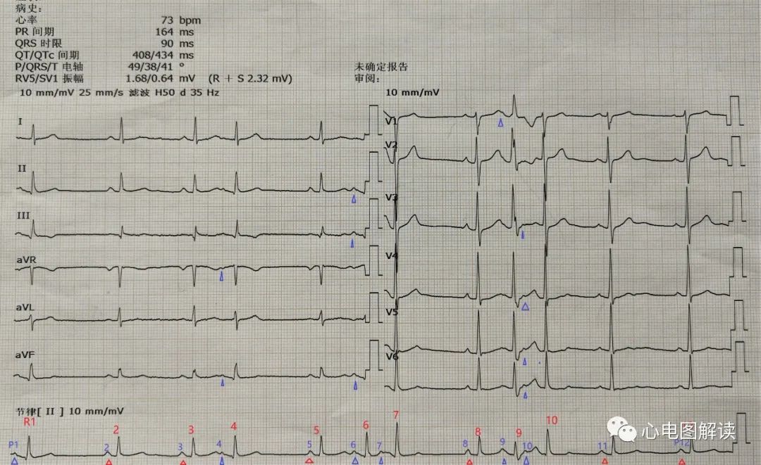房性早搏有时伴心室内差异性传导,房性早搏与反复搏动区别