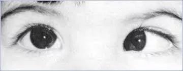 四个方法帮你解决弱视的困扰,弱视治疗小技巧