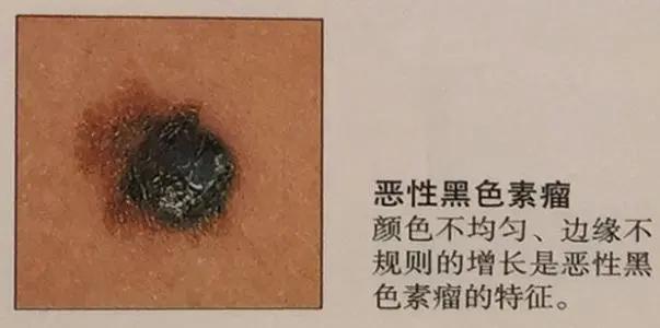 警惕身上长红点,身上长这种斑点竟是癌症前兆