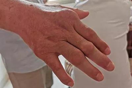 类风湿别瞎折腾,类风湿病病友