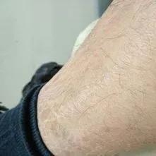 鱼鳞病分类及症状,鱼鳞病怎么区分类型