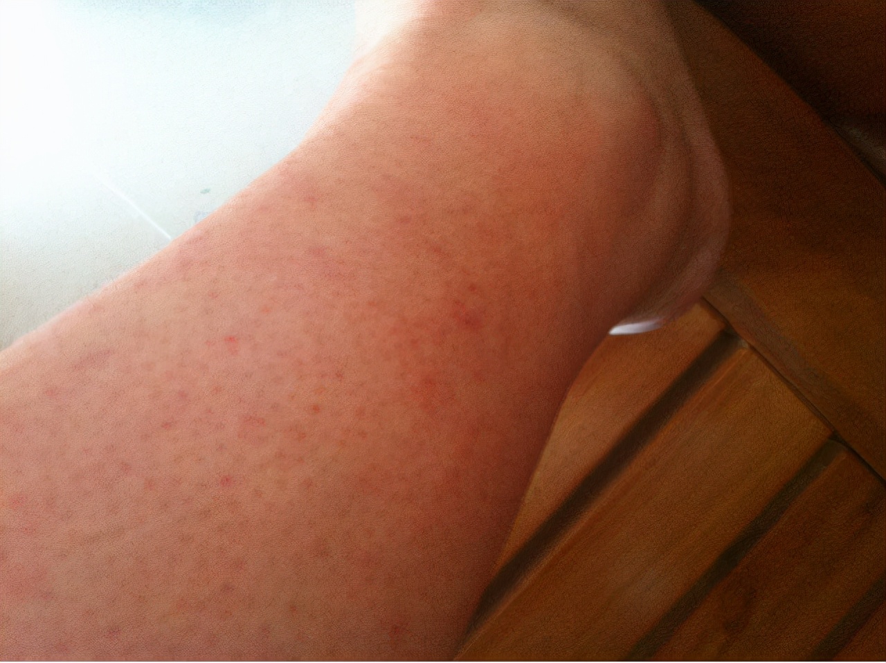 准妈妈夏季保健需要注意的,准妈妈夏季要警惕四种过敏原