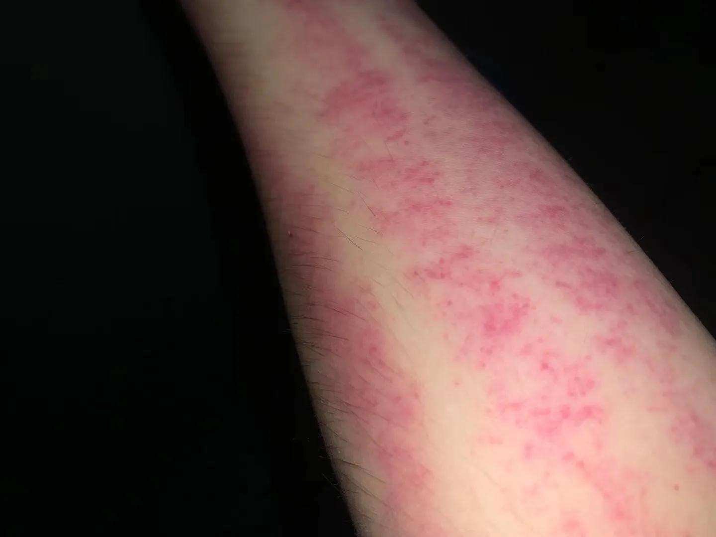 长期熬夜导致胃糜烂,长期熬夜饮食不规律的慢性胃炎