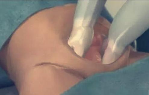 7张图揭露产妇“剖腹产”全过程，男人都该看，网友：母爱太伟大