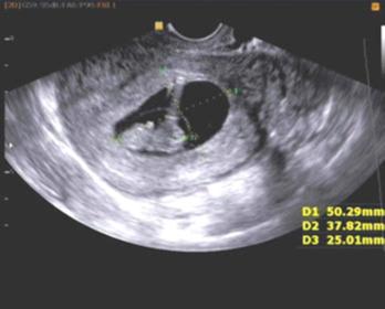 意外怀孕了是药流好还是无痛人流,40岁女性意外怀孕打胎