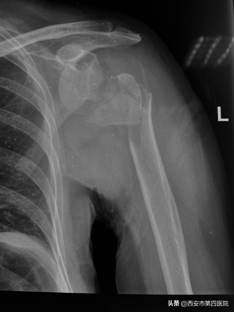 骨科急危重病人抢救应急预案演练,新中心医院骨科