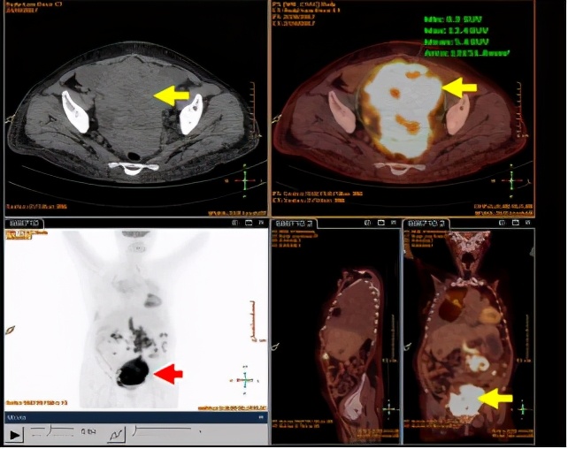 无明显诱因咳嗽、呼吸困难，大量胸腔积液，竟与妇科肿瘤有关？