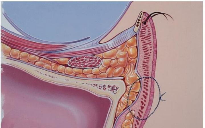 眼袋泪沟黑眼圈整形,24岁眼袋泪沟怎样去除最彻底