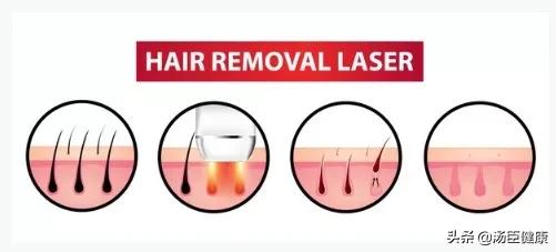 脱毛仪脱毛和激光脱毛哪个好,脱毛仪脱毛方案