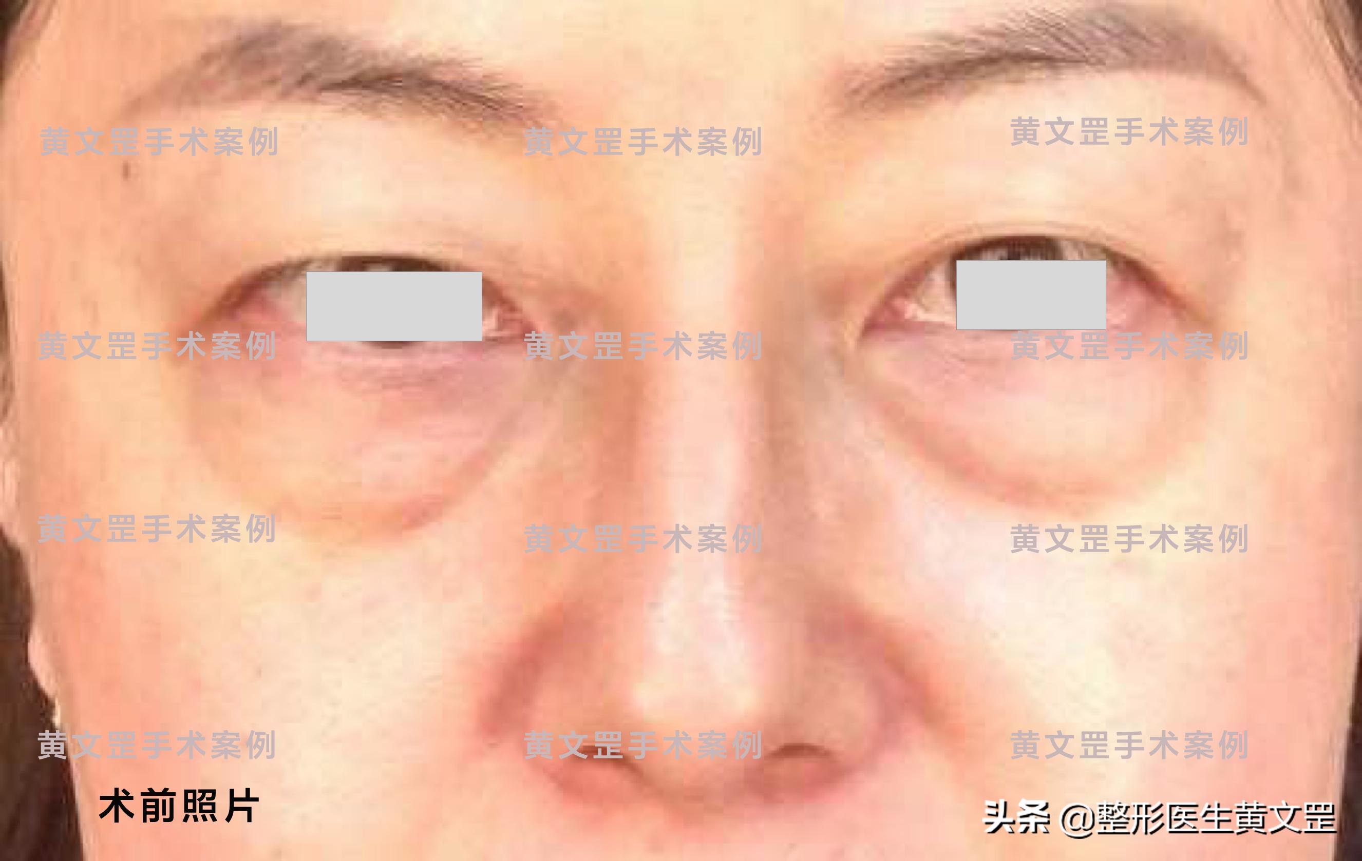 「黄文罡案例」去除眼袋和泪沟，让你年轻10岁