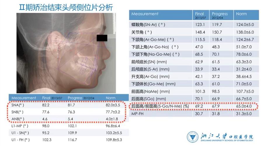 儿童9岁下颌后缩矫治,高角下颌后缩怎么矫治