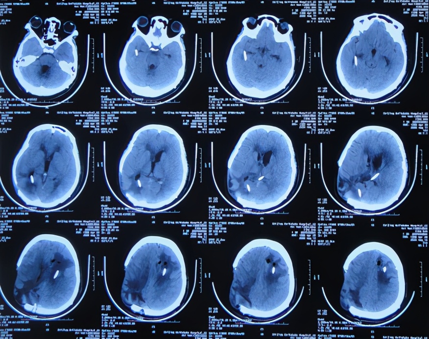 脑室有粘连脑积水有什么办法,脑动脉畸形手术后出现急性脑积水