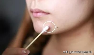 疮有什么症状怎么治,疱疹是怎么引起的