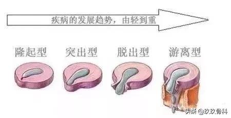 保护腰椎的操,腰椎保健操每天10分钟