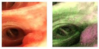 小细胞肺癌的气管镜介入治疗,导航支气管镜在肺癌诊断中的应用