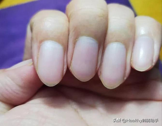 靶向药引起溃疡服什么药好,服用靶向药治疗甲沟炎最佳方法