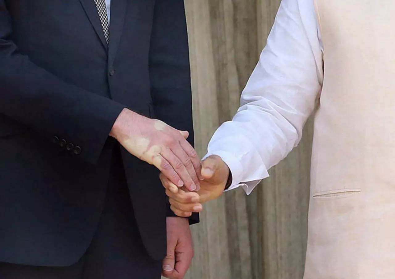 查尔斯的手指肿如香肠,查尔斯王子手指肿如香肠