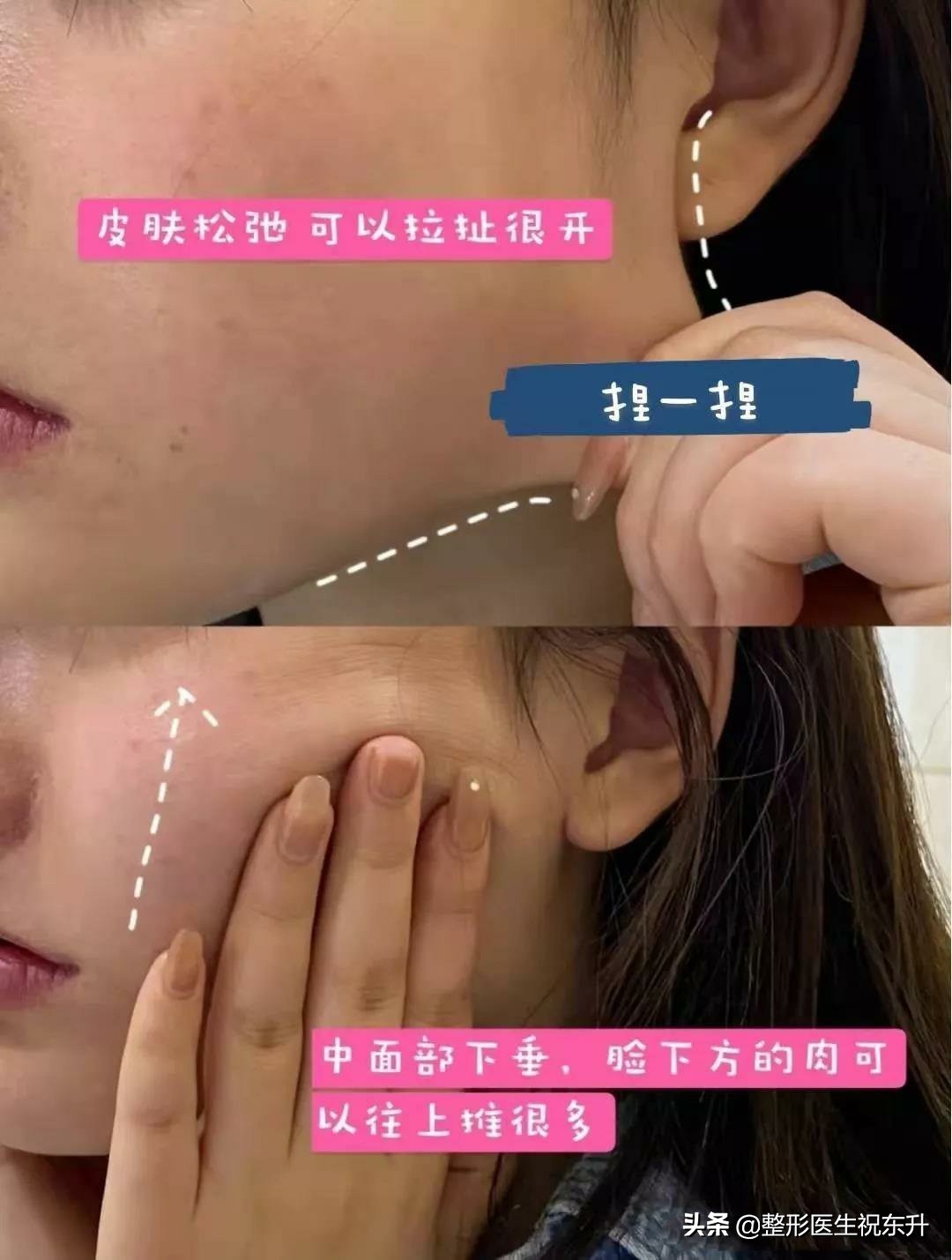 接受不了整形就要正确看待衰老,下颌缘吸脂术后最佳效果多少个月