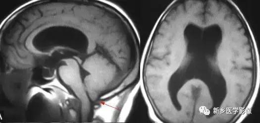 脑室为什么会扩张,脑室为什么会变小