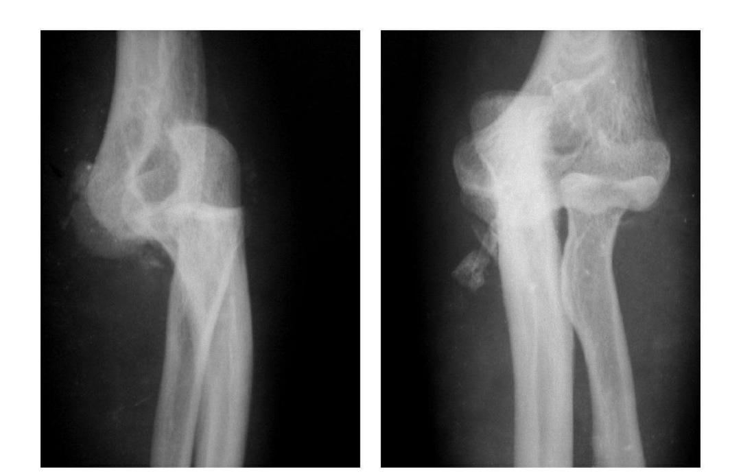 青少年肘部损伤最常见的是,肘部桡神经损伤的临床表现