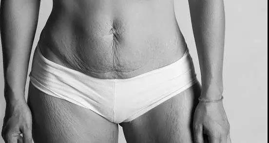 肥胖纹很严重怎么消除,有效去除肥胖纹的方法