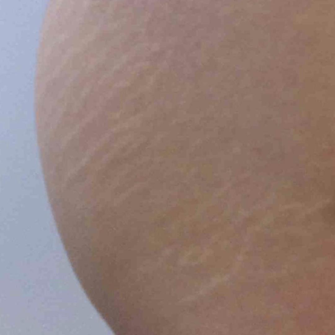 医生推荐防妊娠纹,搞定妊娠纹几十块钱就够了