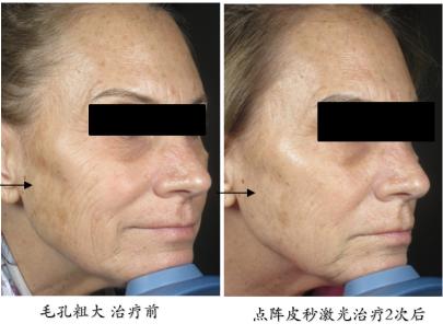 皮秒激光伤皮肤吗,皮秒激光能治凹陷疤痕吗