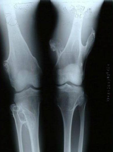 孩子腿上长了个软骨瘤该怎么办,儿童腿部内生软骨瘤耽误生长么