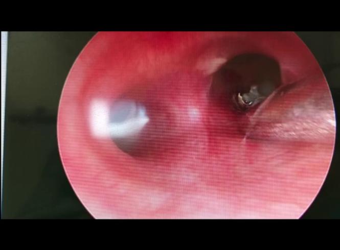 11岁男孩反复发烧退不下去怎么办,14岁男孩反复发烧去医院检查