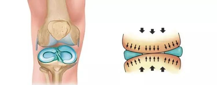 半月板损伤干细胞,半月板损伤干细胞注射液价格