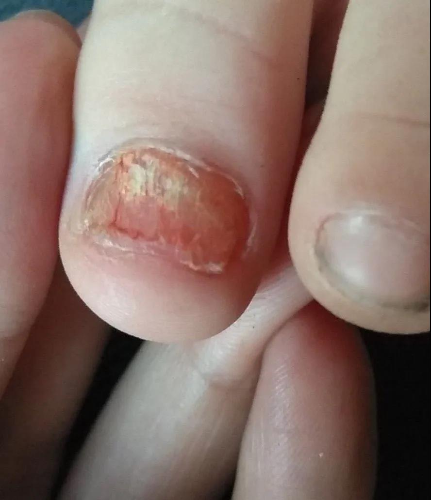 冬季指甲皲裂起皮,指甲变薄是真菌感染的哪种
