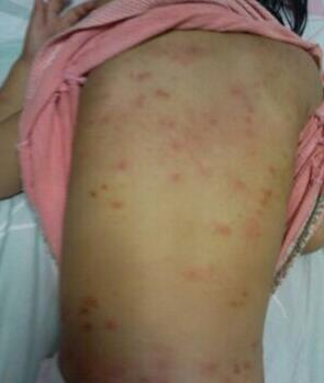 跳蚤传染什么疾病,跳蚤一直吸血怎么办