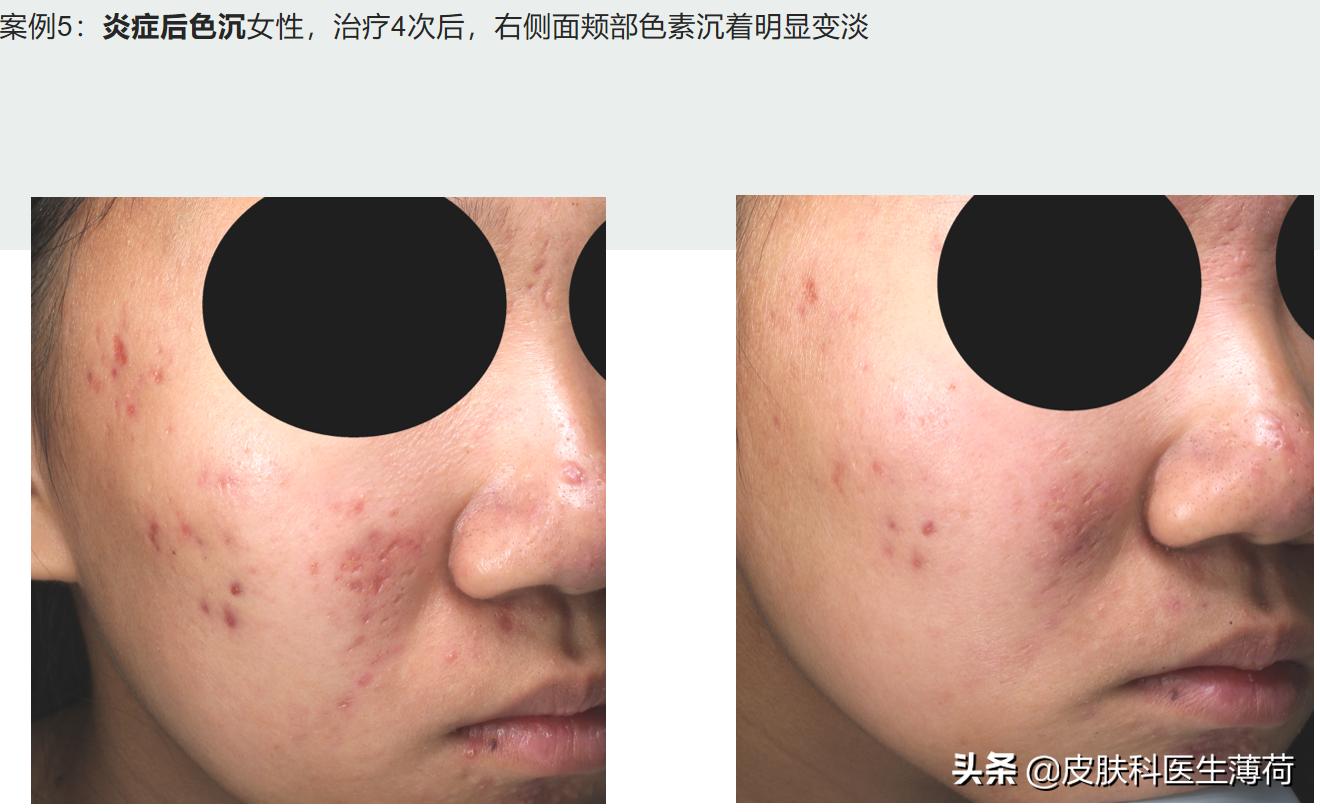 水杨酸精华果酸去闭口粉刺,刷酸去黑头收缩毛孔用哪个产品好